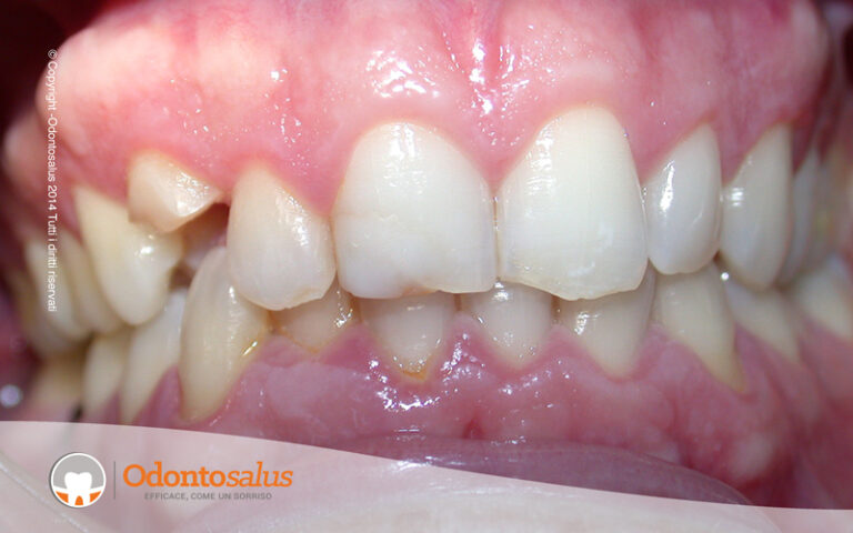 01OTTURAZIONI-cas3-1