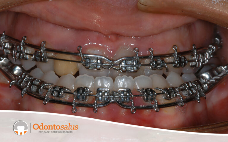 02Chiusura-dentale-pre-intervento