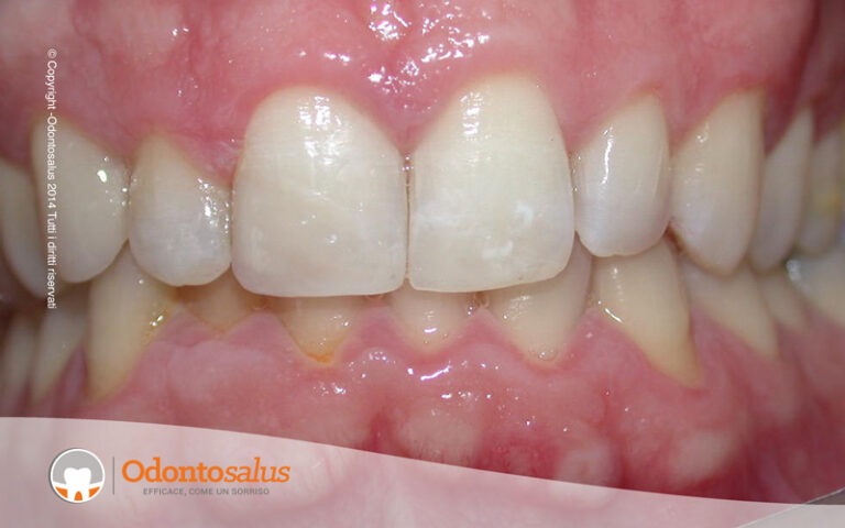 02OTTURAZIONI-cas3-2