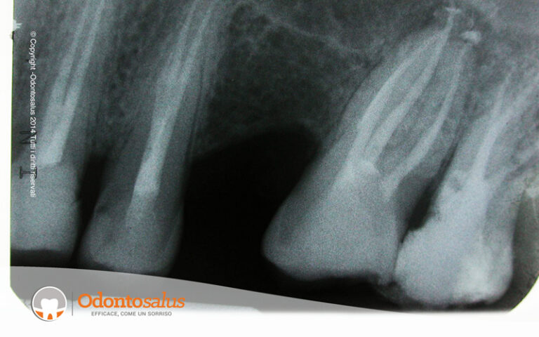 02dopo-devitalizzazione