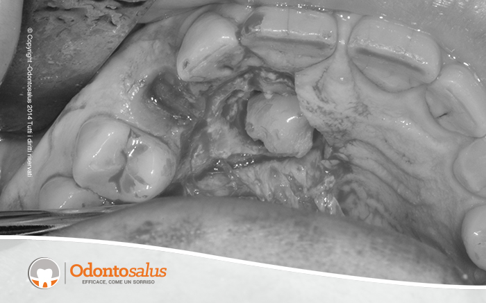 03inicisione-lembo-e-scopertura-canino