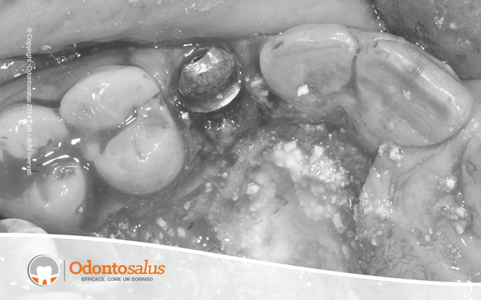 05inserz-impianto-e-riempimento-con-osso