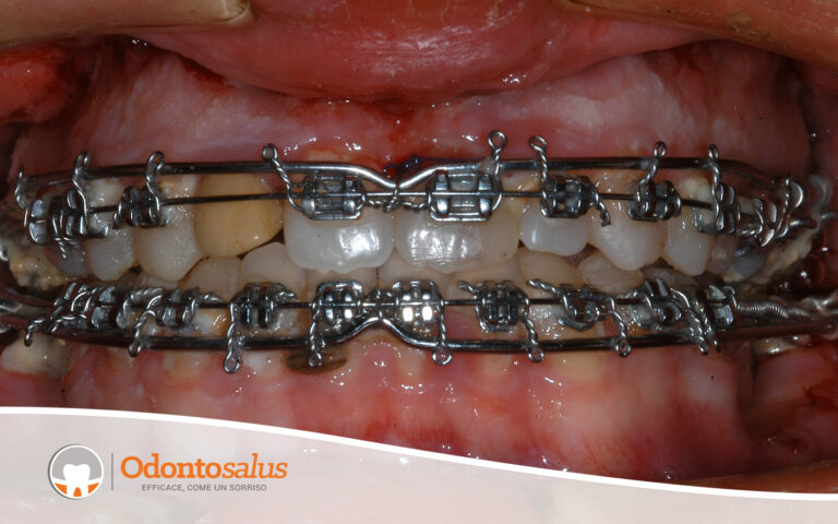 09Chiusura-dentale-post-intervento