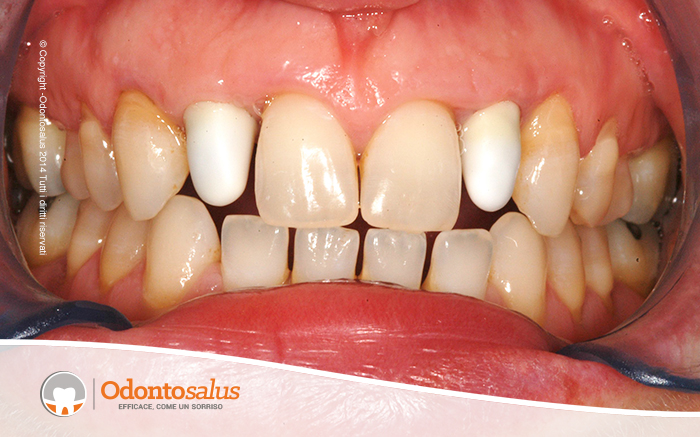 protesi_fissa07