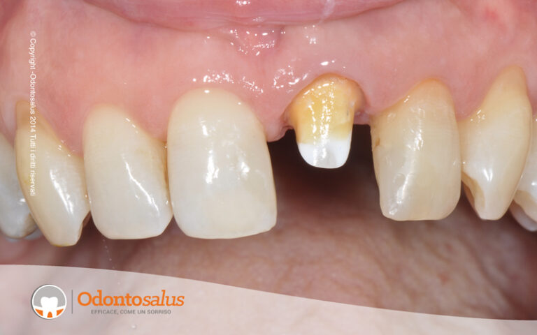 protesi_fissa_naturale01