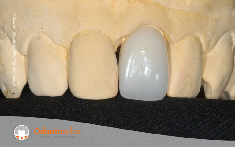 protesi_fissa_naturale02