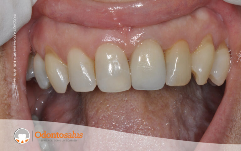 protesi_fissa_naturale03