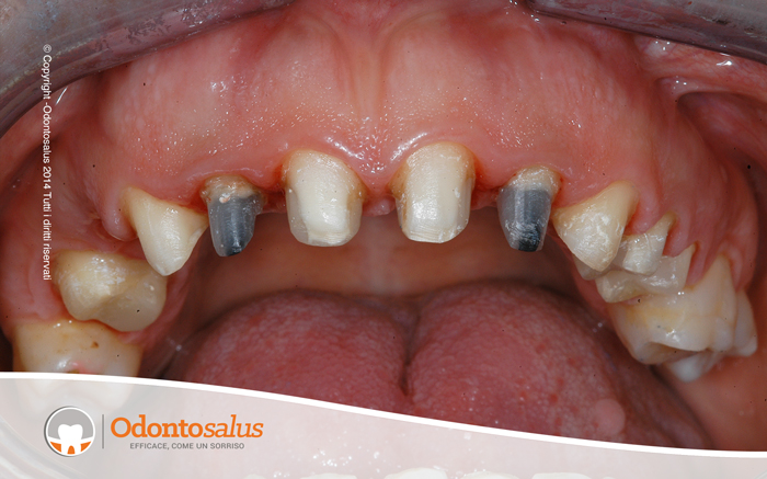 protesi_fissa_naturali01
