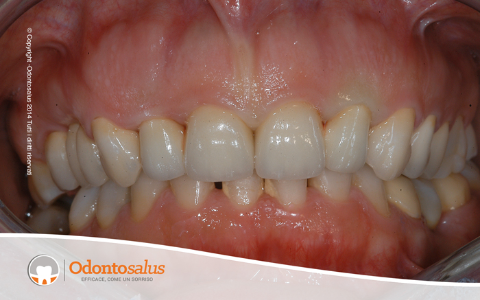 protesi_fissa_naturali02