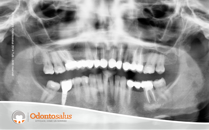 protesi_fissa_naturali03